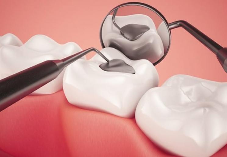 Trám răng sâu chính là giải pháp đơn giản và nhanh nhất để giải quyết tình trạng sâu răng.