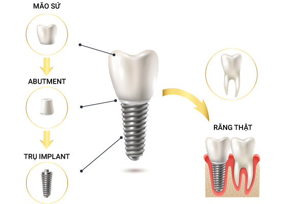 Phương pháp cấy ghép răng Implant