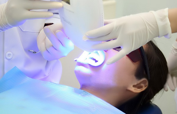 Tìm hiểu phương pháp tẩy trắng răng phổ biến nhất ở thời điểm hiện nay