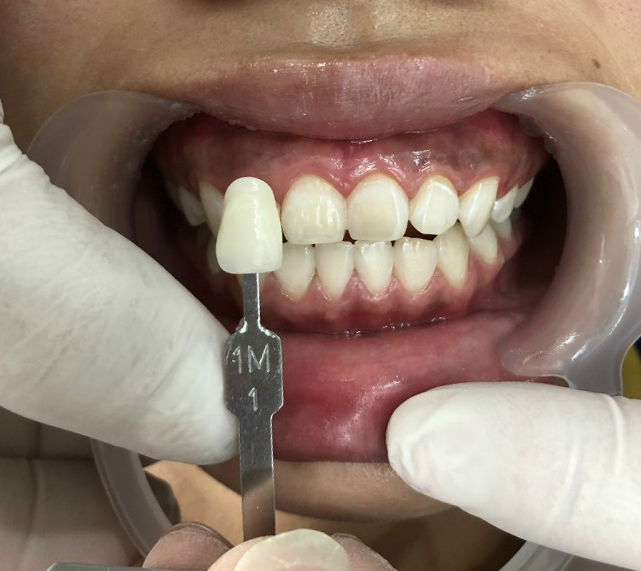 KH1: Sau khi tẩy trắng răng