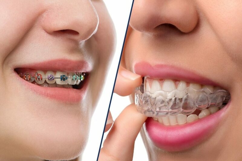 Niềng răng thẩm mỹ hiện đang là phương pháp được nhiều người lựa chọn sử dụng