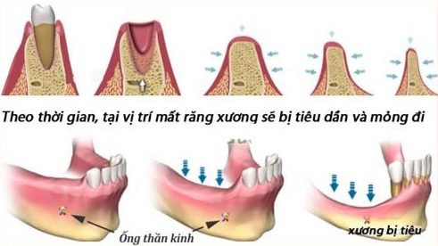 răng bị tiêu xương