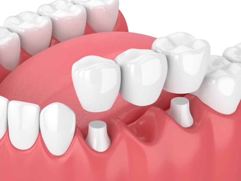 Kỹ thuật mài răng ảnh hưởng trực tiếp đến chất lượng răng sứ