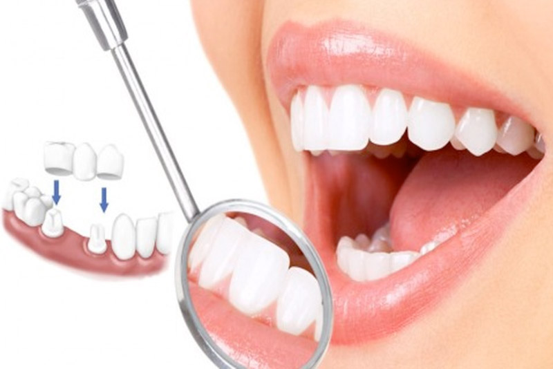 Bọc răng sứ thẩm mỹ là phương pháp làm đẹp được nhiều người ưa chuộng