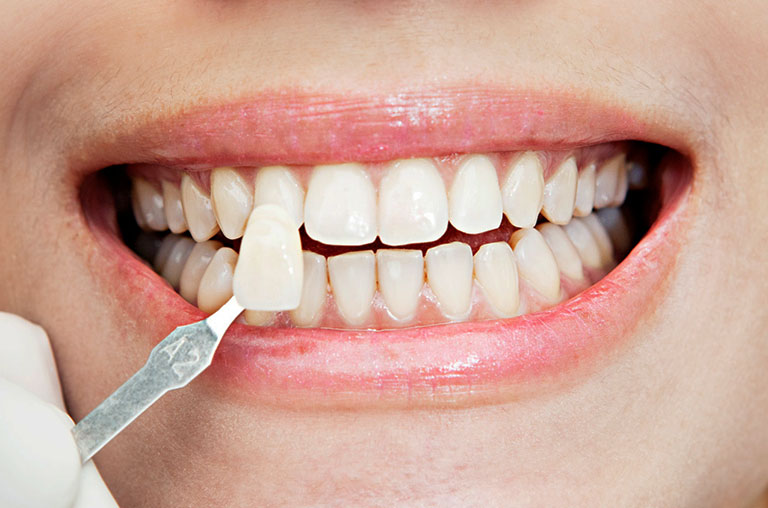 Phương pháp dán sứ veneer không gây tổn thương đến men răng