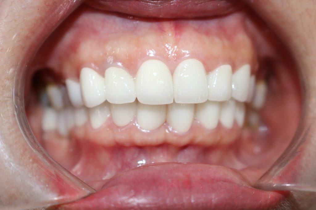 Bọc sứ đúng kỹ thuật cho hàm răng ổn định, không có mùi hôi