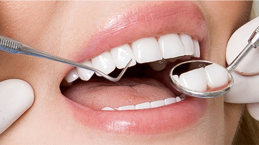 Bọc răng sứ là gì? Những điều cần lưu ý khi bọc răng sứ