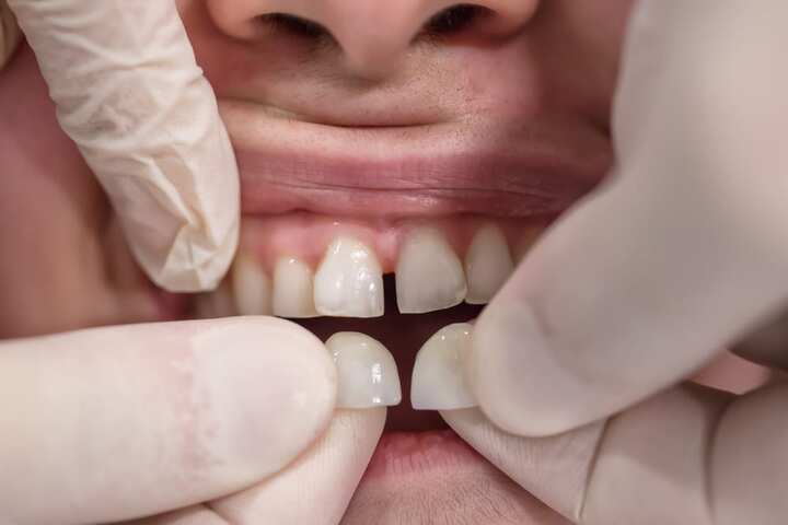 Có rất nhiều dáng răng, bạn nên nhờ bác sĩ tư vấn form phù hợp nhất