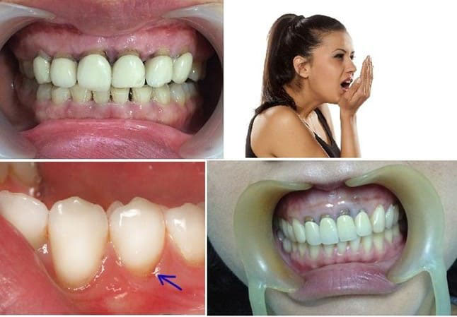 Bọc răng sứ không hề gây ra bệnh hôi miệng