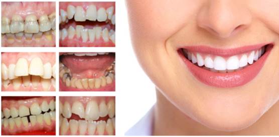 Bọc răng sứ thẩm mỹ dành cho những người có khiếm khuyết về răng
