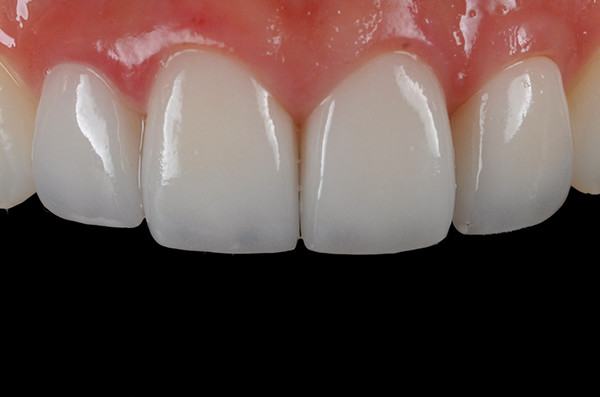 Răng toàn sứ mang đến hàm răng giống với tự nhiên nhất