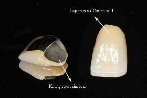 Răng sứ kim loại thường dùng