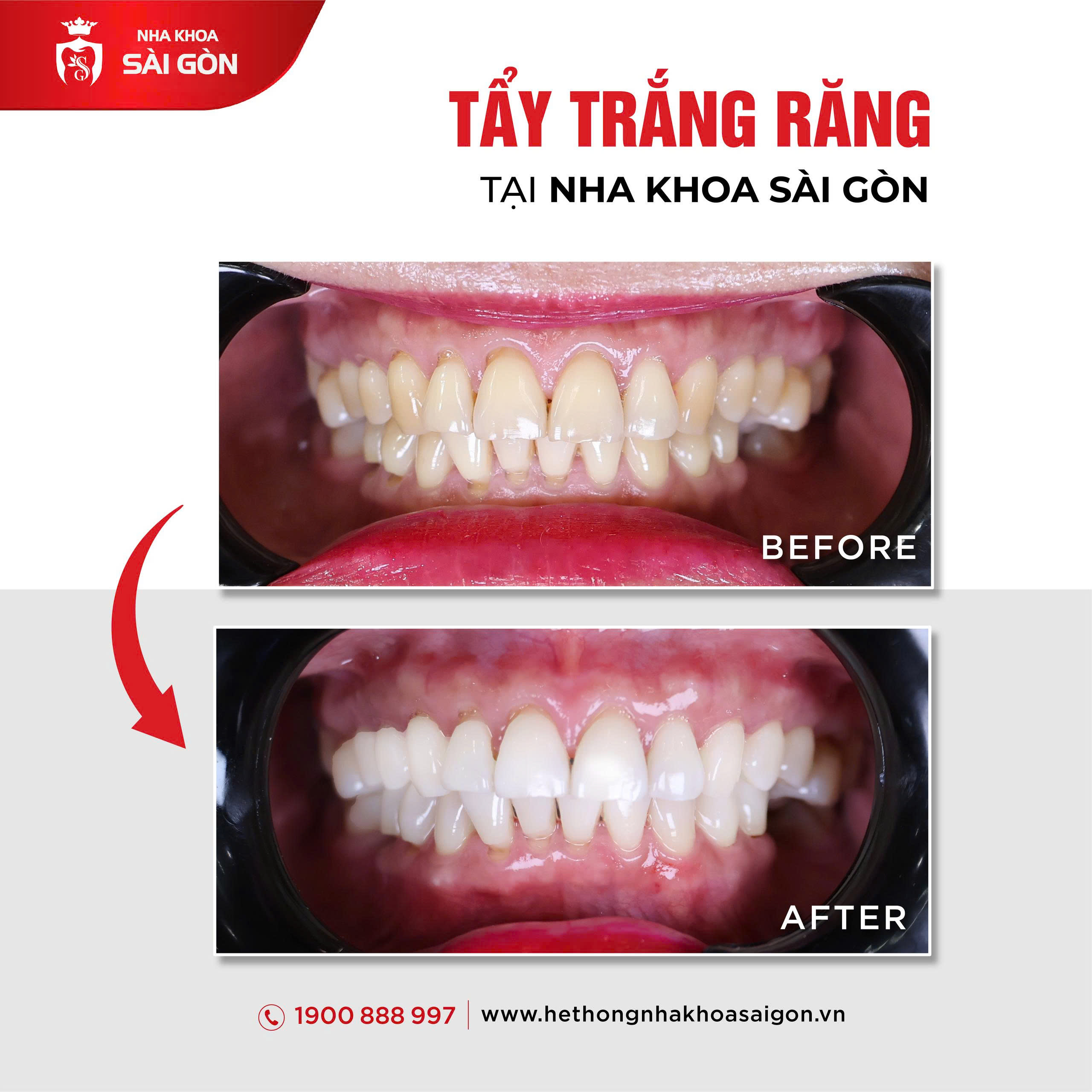 Kết quả tẩy trắng răng trước và sau tại Nha Khoa Gài Gòn