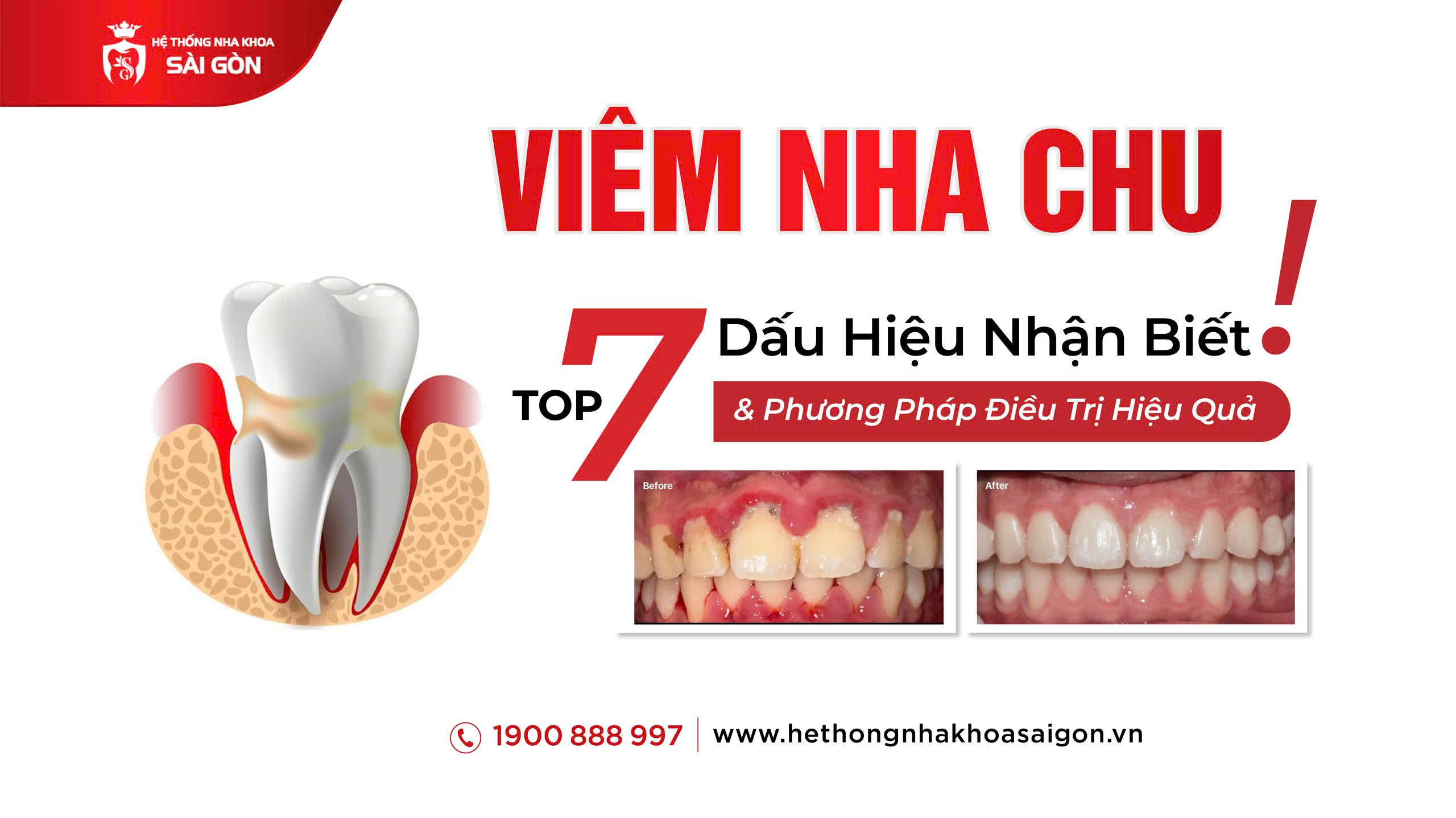 điều trị viêm nha chu hiệu quả