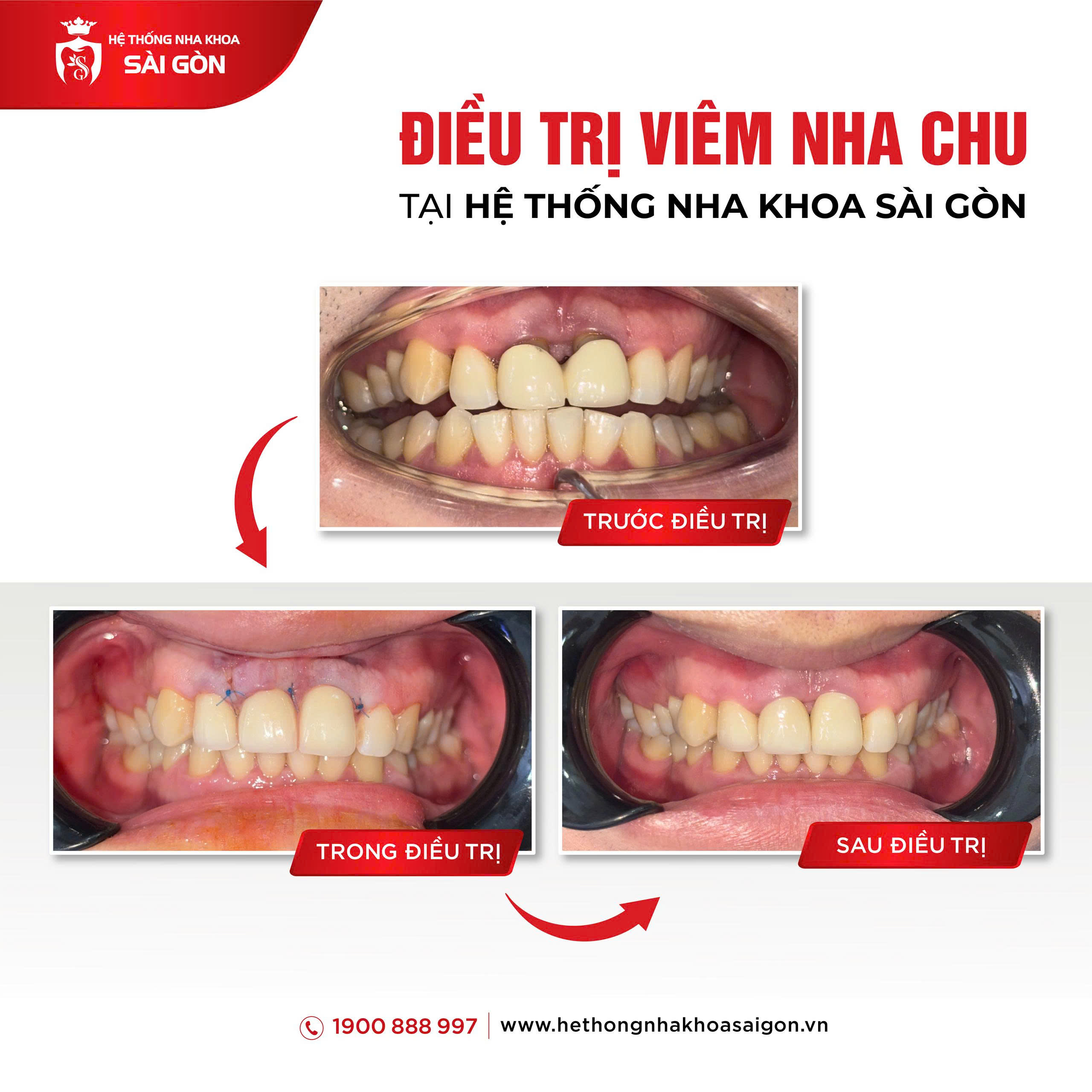 điều trị viêm nha chu trước và sau