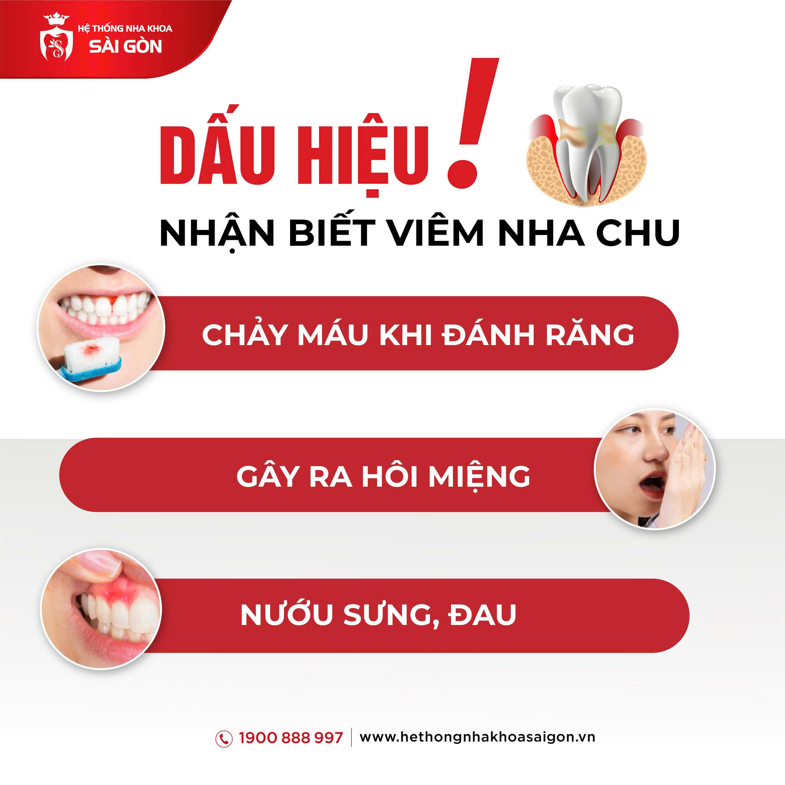 dấu hiệu nhận biết viêm nha chu