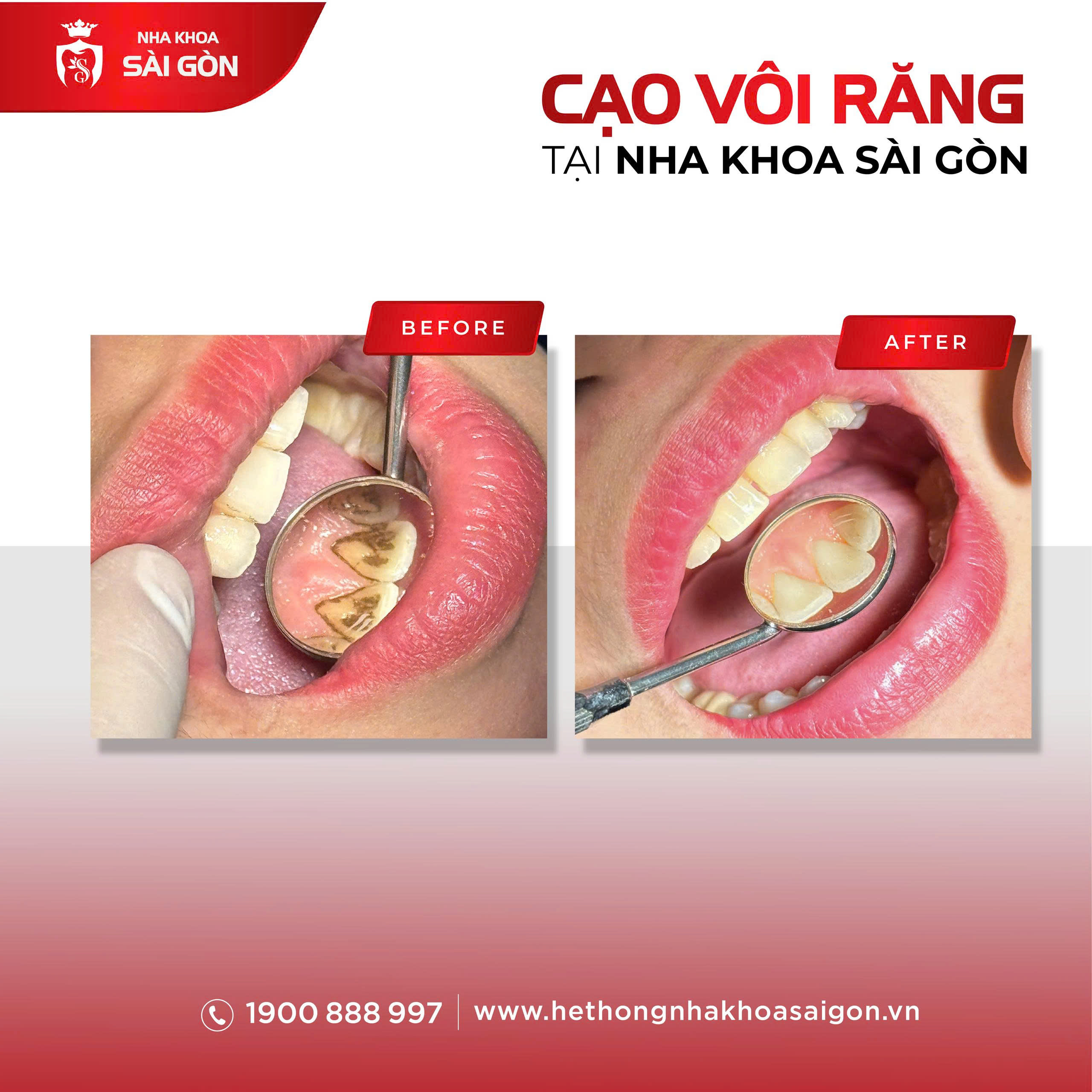Kết quả cạo vôi răng trước và sau điều trị tại Nha Khoa Sài Gòn