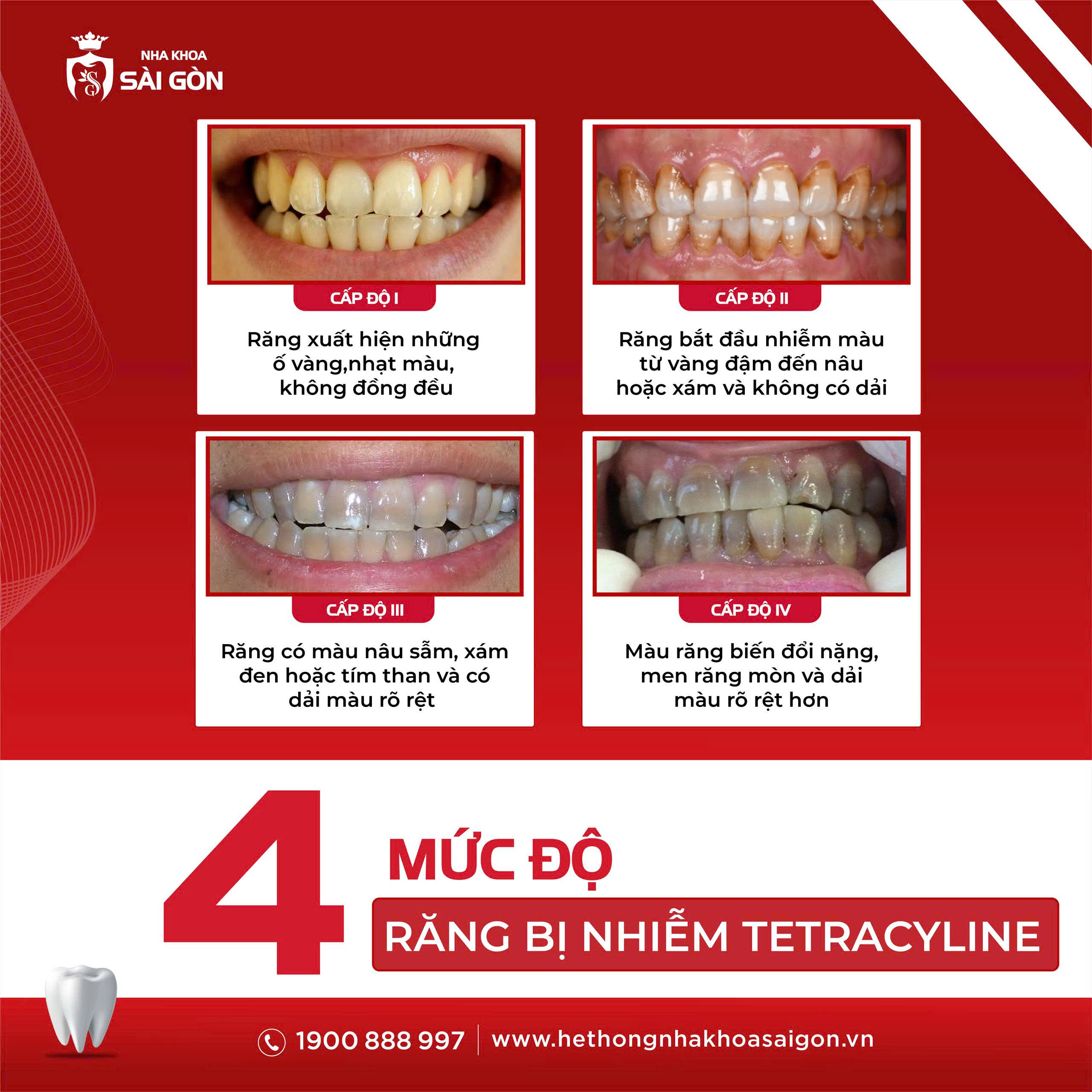 4 mức độ răng nhiễm tretracycline