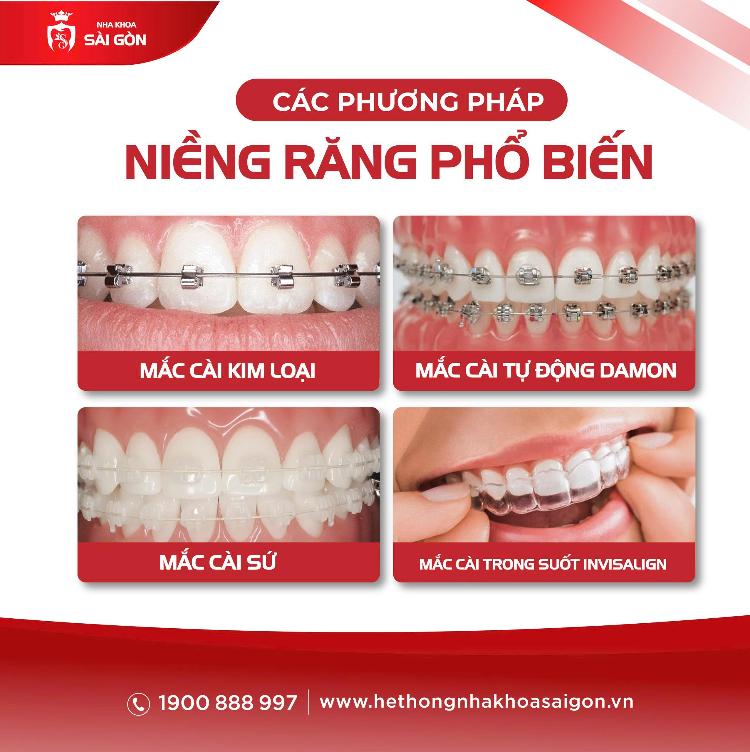 các phương pháp niềng răng tại Nha Khoa Sài Gòn