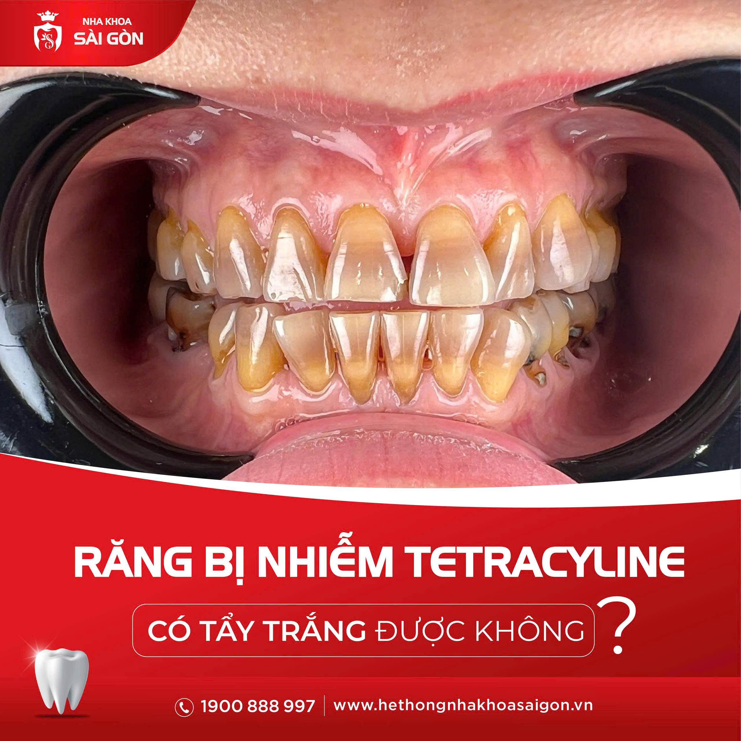 Khách hàng thực tế nhiễm Tetracycline