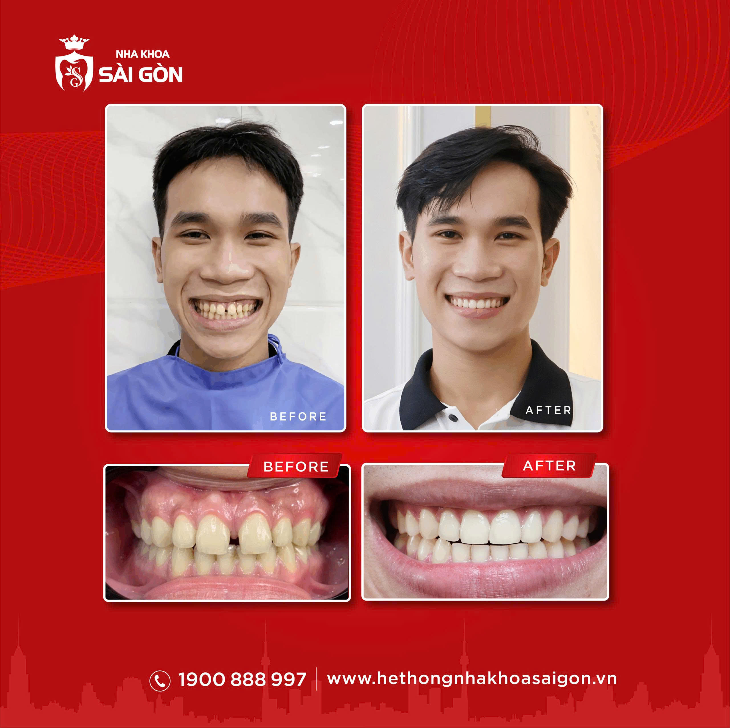 kết quả niềng răng thưa thực tế tại nha khoa sài gòn