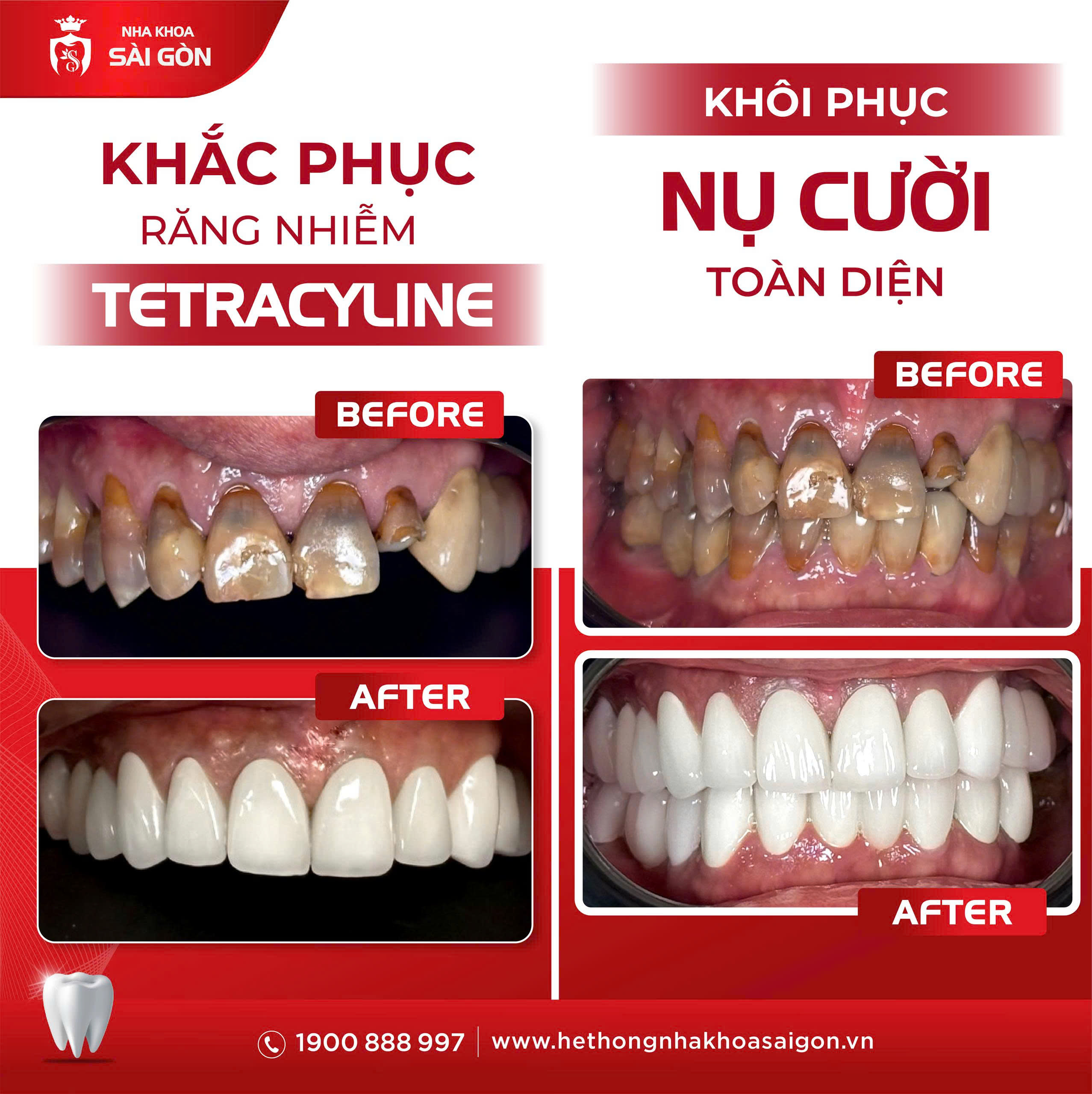 khi nào cần bọc răng sứ cho răng nhiễm tetracycline