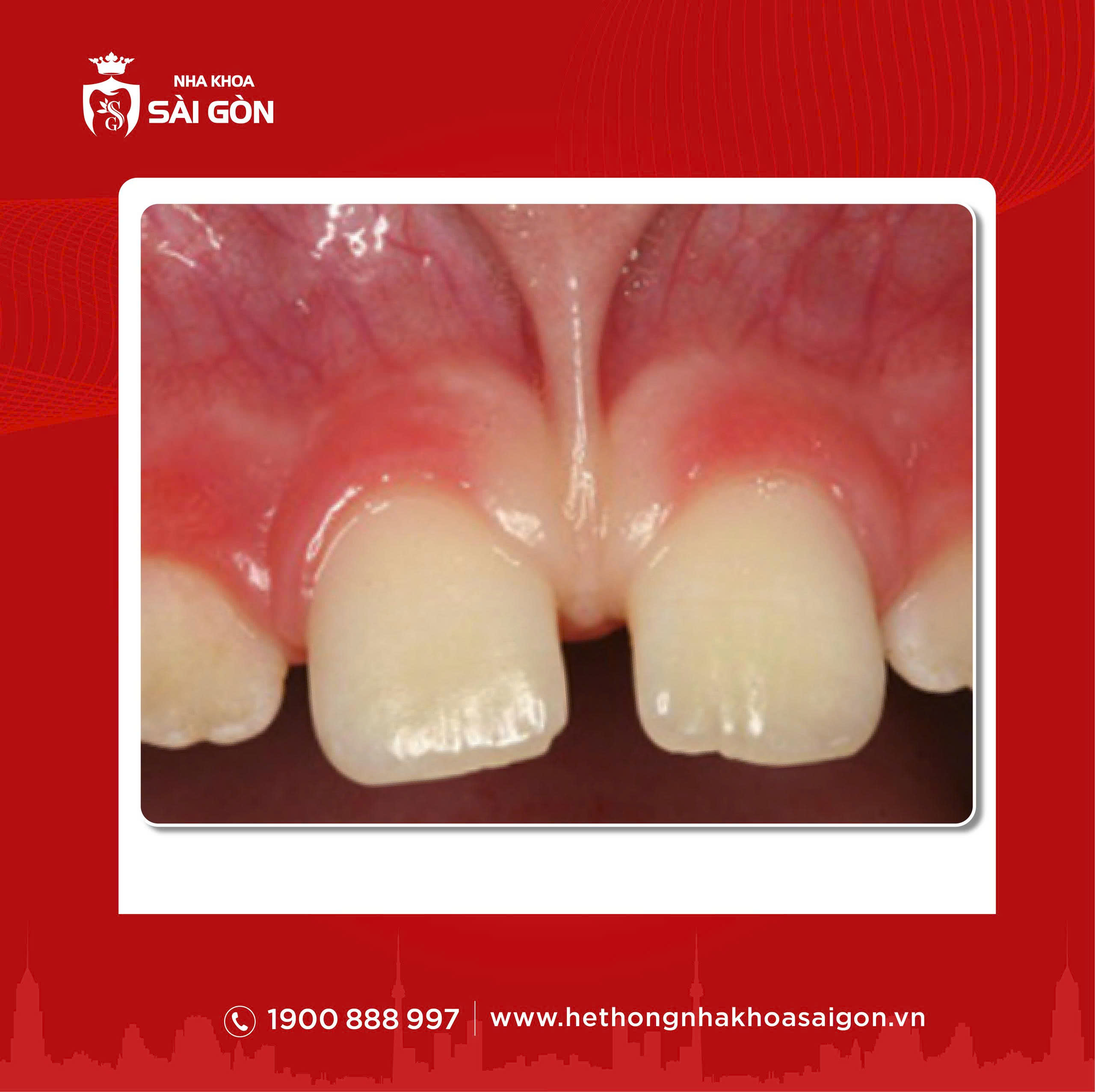 nguyên nhân răng cửa thưa do phanh môi bám thấp