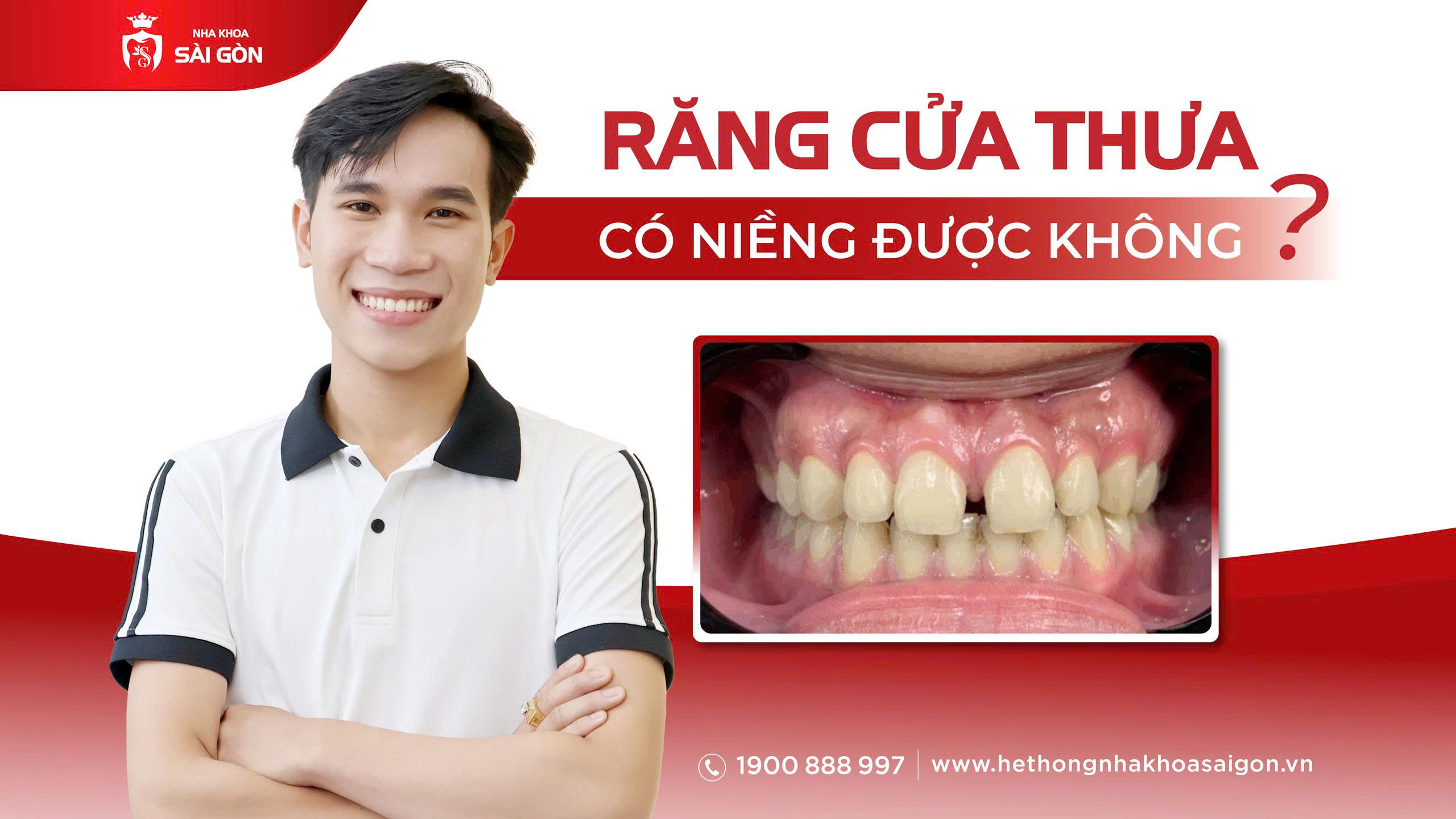 răng cửa thưa có niềng được không tại Nha Khoa Sài Gòn