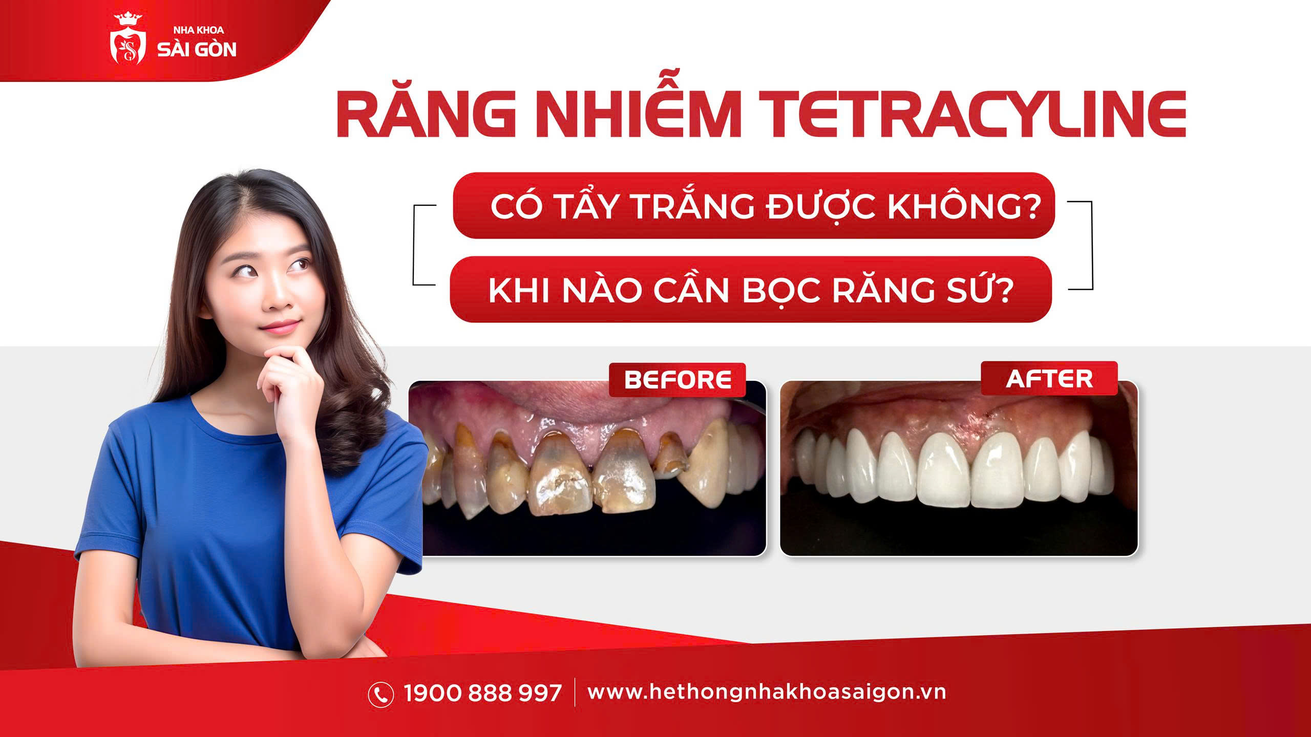 răng nhiễm tetracycline có tẩy trắng được không