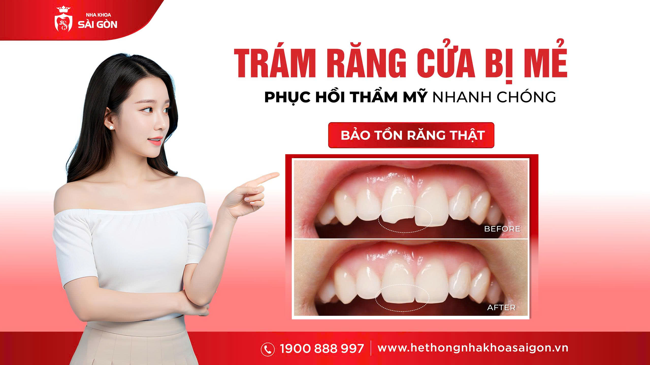 Trám răng cửa bị mẻ bằng vật liệu Composite