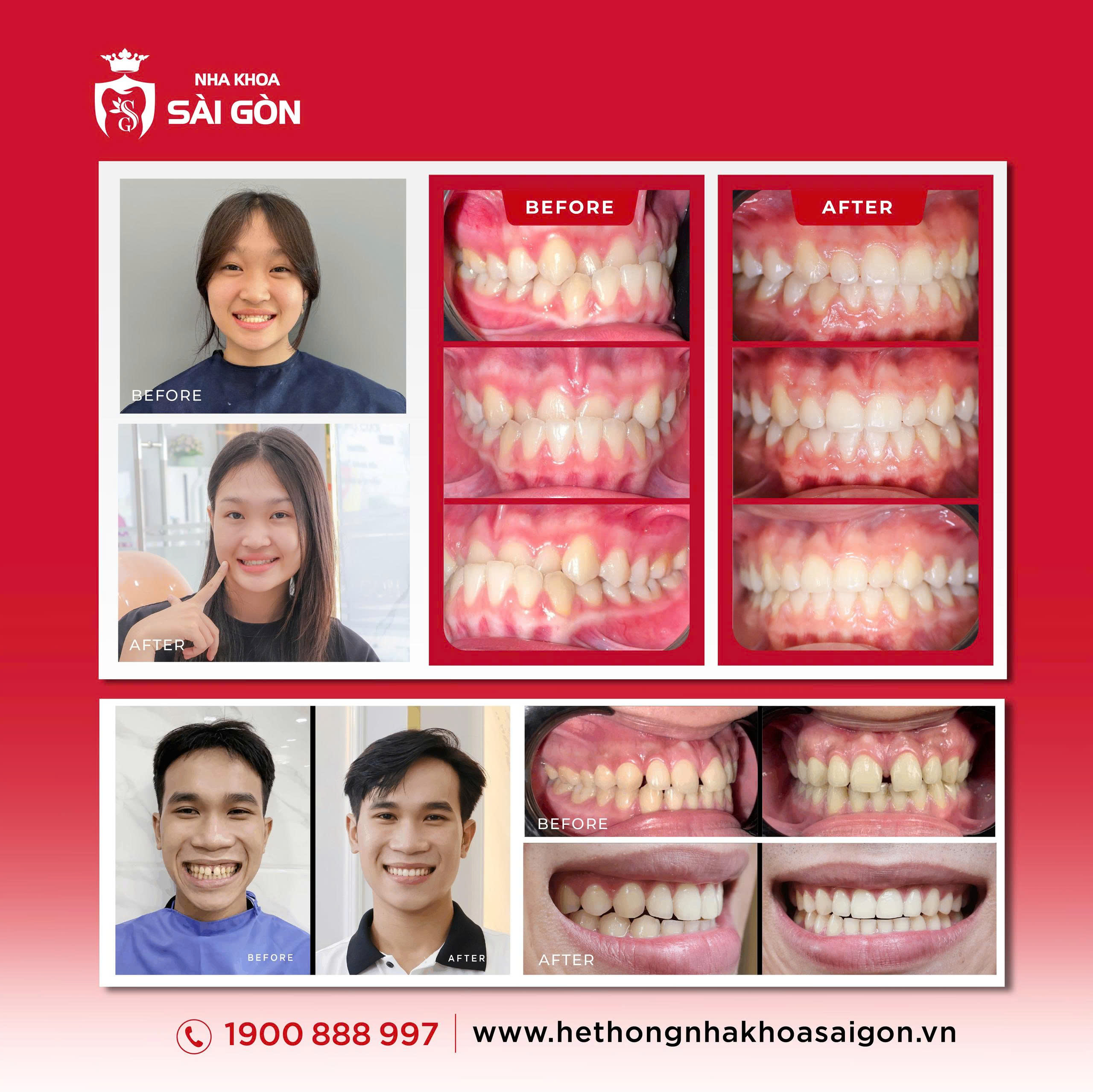 kết quả niềng răng mắc cài tại nha khoa sài gòn
