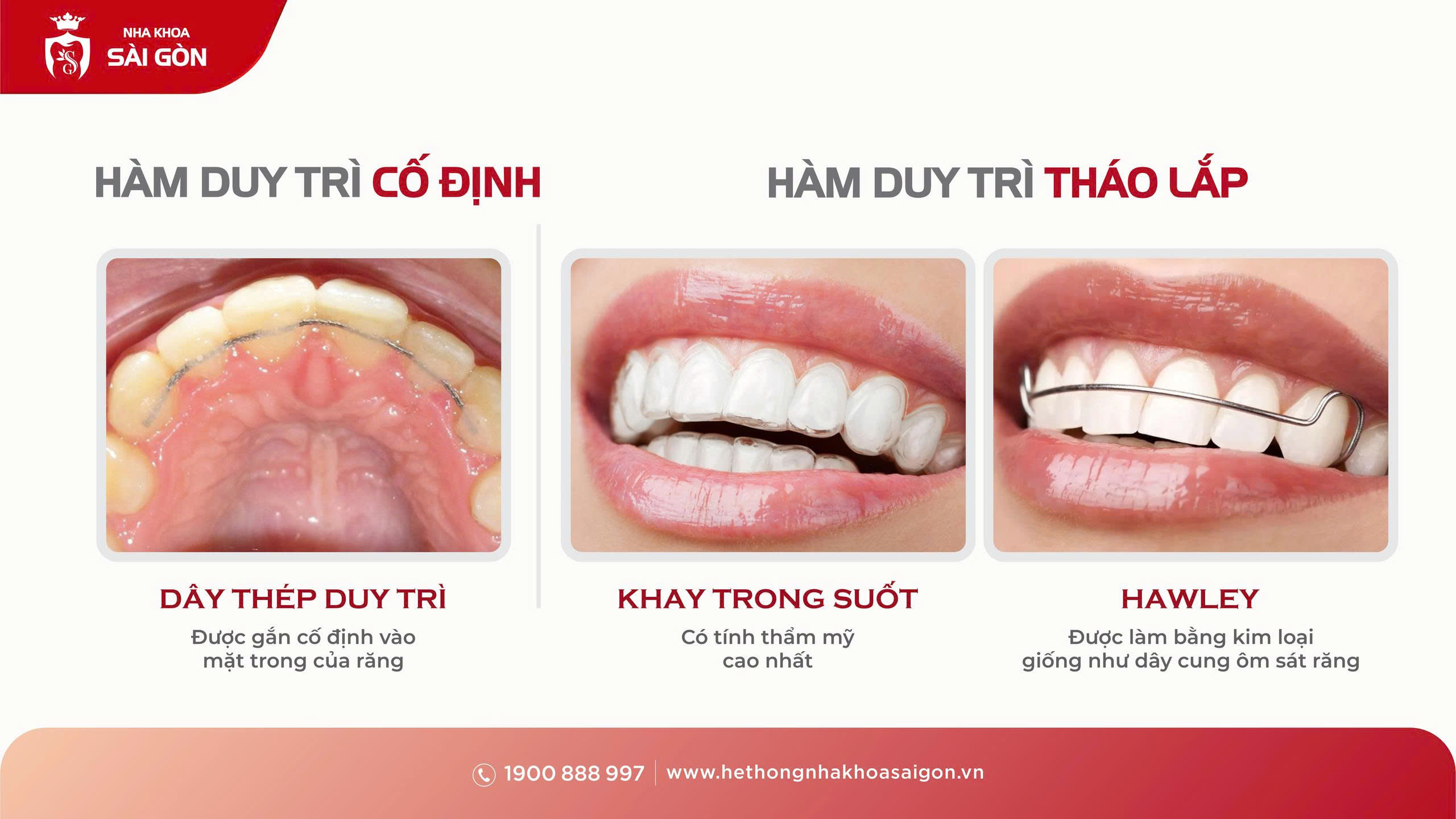 Hai loại hàm duy trì phổ biến: tháo lắp và cố định