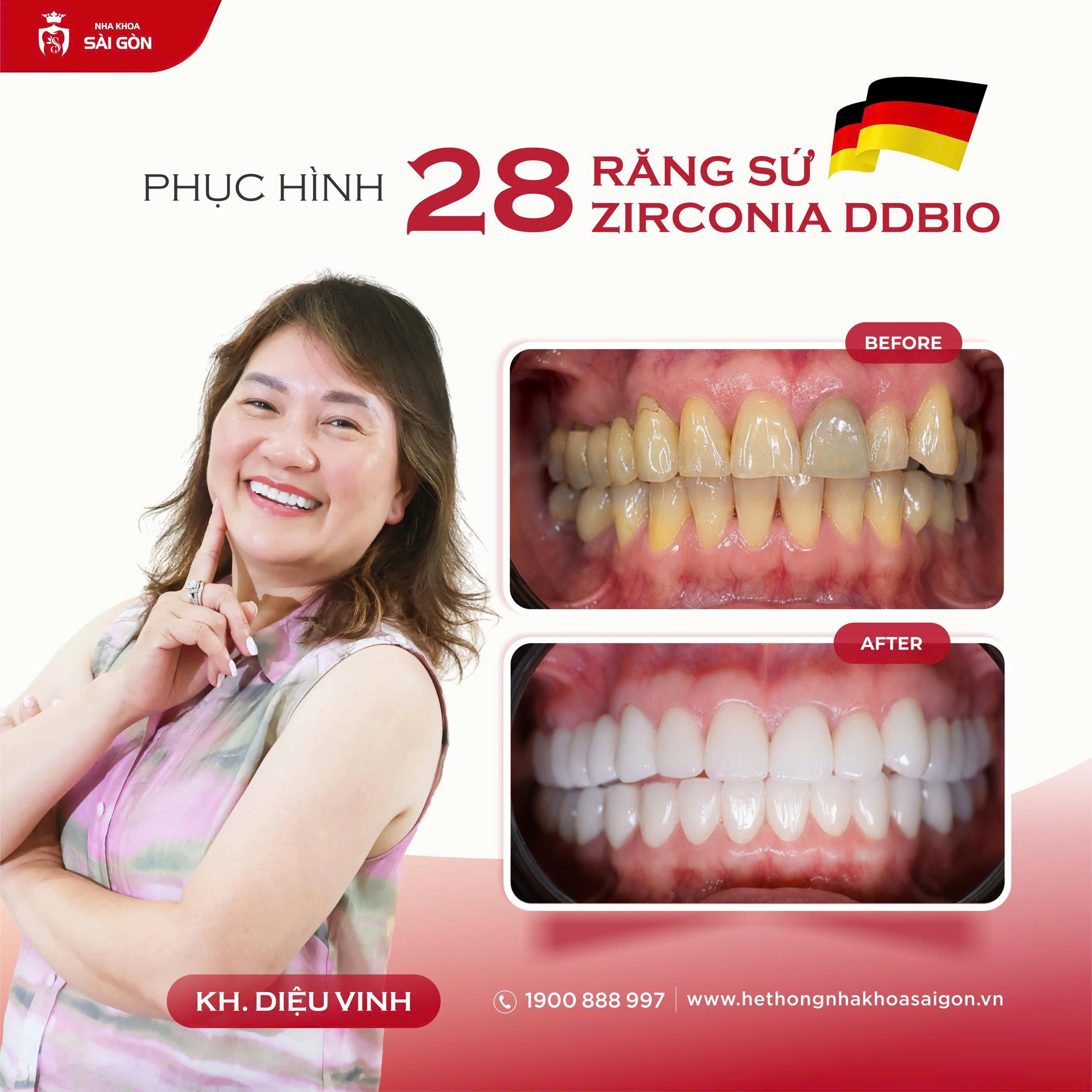 Nụ cười tự nhiên sau khi bọc răng sứ Zirconia DDBio chính hãng